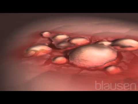 Eczema Animation