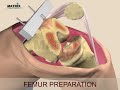 Total Knee Replacement - HD