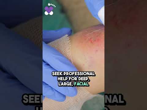 Burn Care Essentials Guide | Quick Healing Tips & Medical Advice 🔥🏥