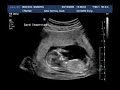 Ultrasound at 12 weeks gestation