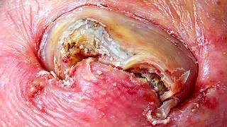 Ingrown Nails That Grow Tenaciously, Dig Out The Nails Hard!【Xue Yidao】