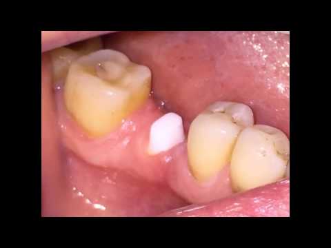 CeraRoot zirconia implants placed by Dr. Veselin Shumantov, New York City