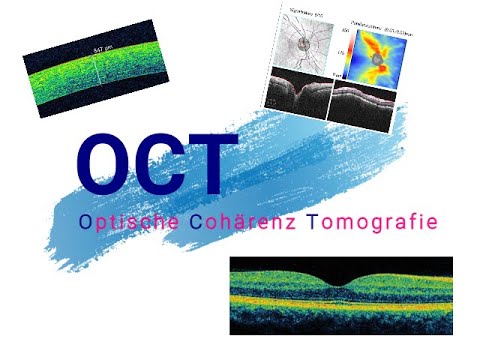 OCT - Optische Cohärenztomografie - Tipps und Tricks für eine gute Bildqualität