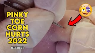 EXTRACTION OF A PINKY TOE CORN THAT HURTS ALOT BY MISS FOOT FIXER