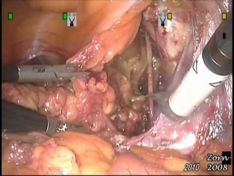 Robotic Radical Prostatectomy - STEP 2-  Pelvic Lymph Node Dissection