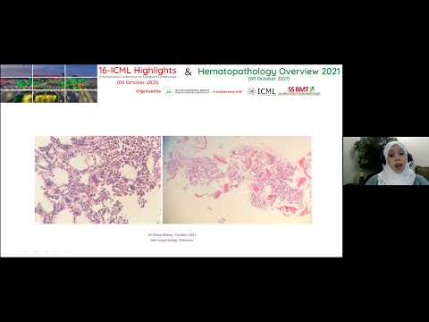 Pure red cell aplasia review: Dr. Mona Alfaraj- Hematopathology Overview 2021 - 09 Oct 2021