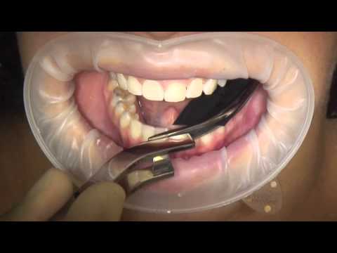 Bausch Articulatiepapier Hoefijzer Micro Dun Blauw Rood 40µ