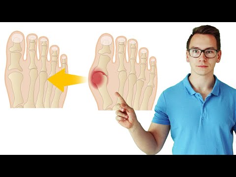 Treat hallux valgus with 3 exercises (without surgery!)