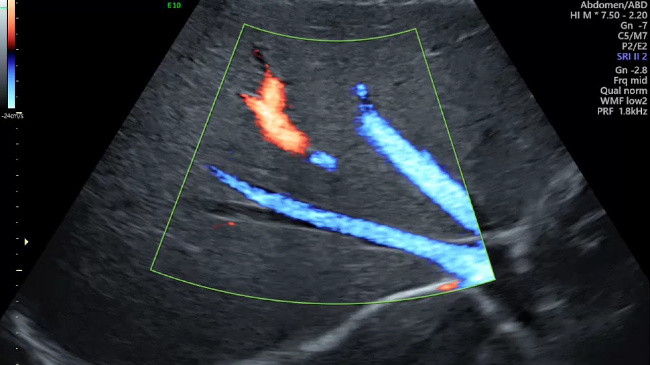AVALIAÇÃO DE CIRCULAÇÃO  EPÁTICA DOPPLER DE VEIA PORTA