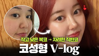 작고 낮은 복코가 예뻐지는 법 | 코성형 브이로그