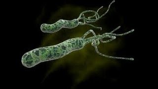 Helicobacter pylori (H.pylori) Simplified