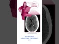 Diagnostics On Demand Subdural Hematoma