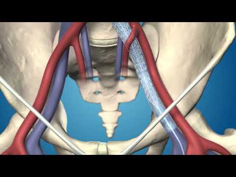 Medtronic's Abre™ Venous Self-Expanding Stent System product animation