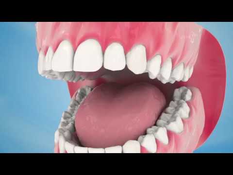 Dental Implant Procedure