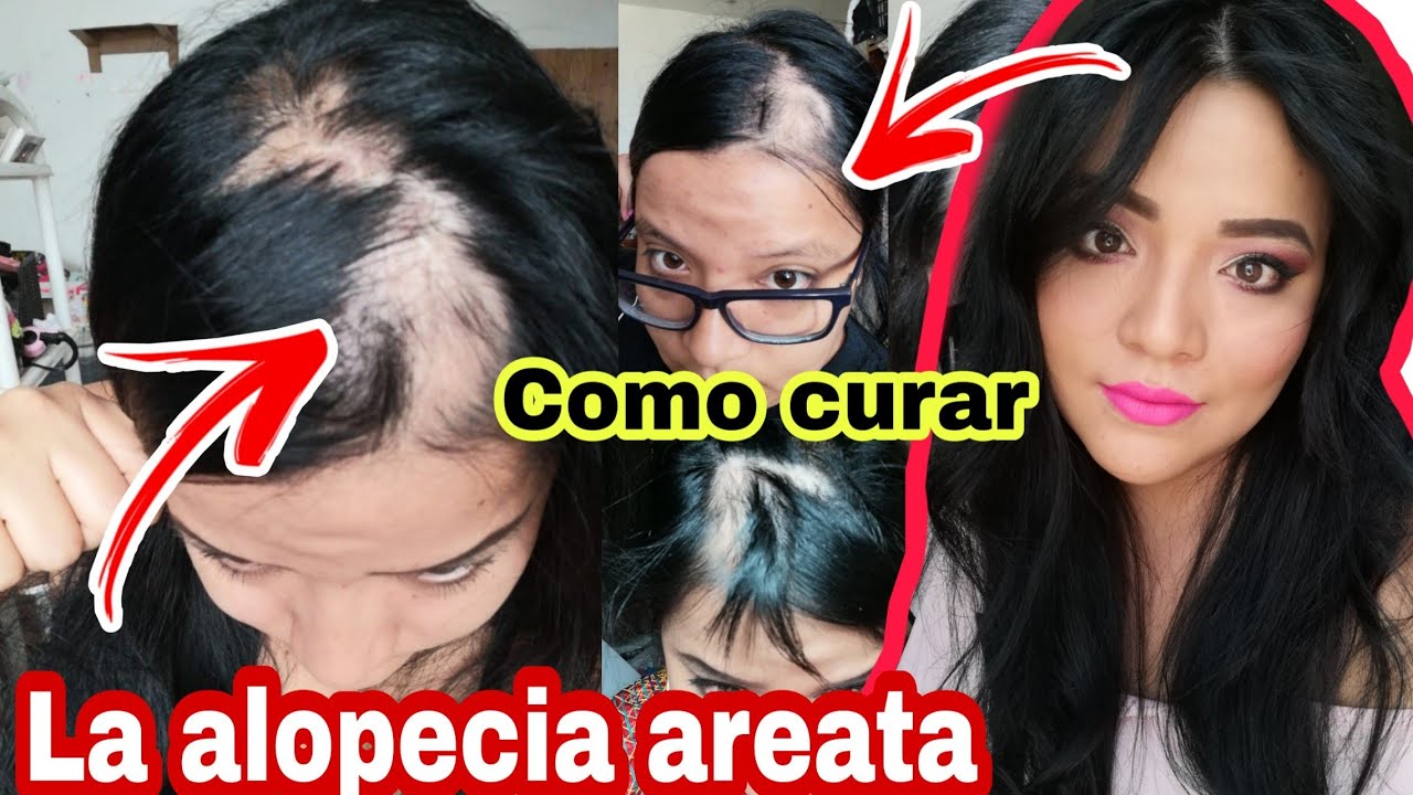 COMO CURAR LA ALOPECIA AREATA - MI TRATAMIENTO - CAIDA DE CABELLO