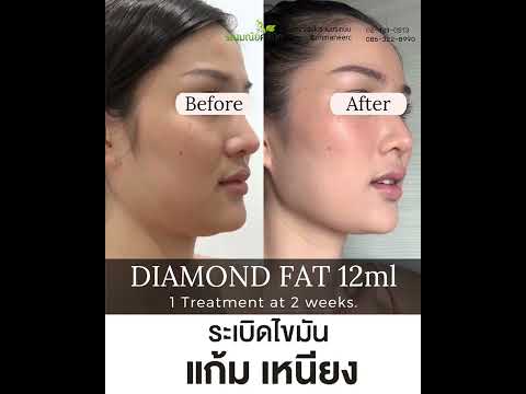เมโสแฟต ยี่ห้อไหนดี