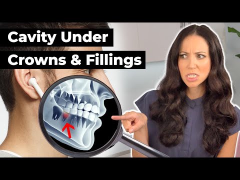 Tooth Decay Under a Crown | Recurrent Decay Explained