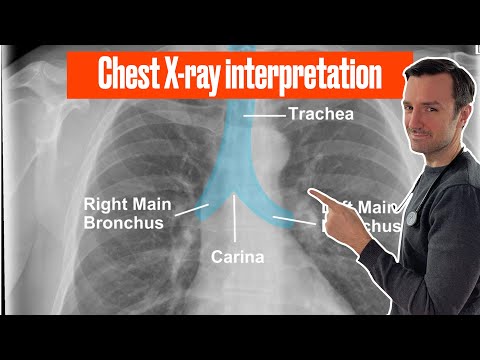 , title : 'Chest X ray interpretation (in 10 minutes) for beginners🔥🔥🔥 #chestxray #cxr'