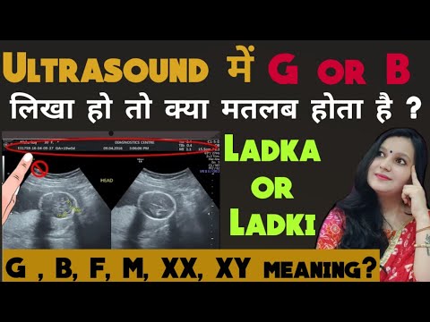 ultrasound me M, F, G, B, XX, XY ka kya matlab hota hai ।kya sach me gender prediction kar skte hai