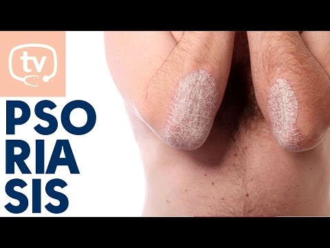 La psoriasis