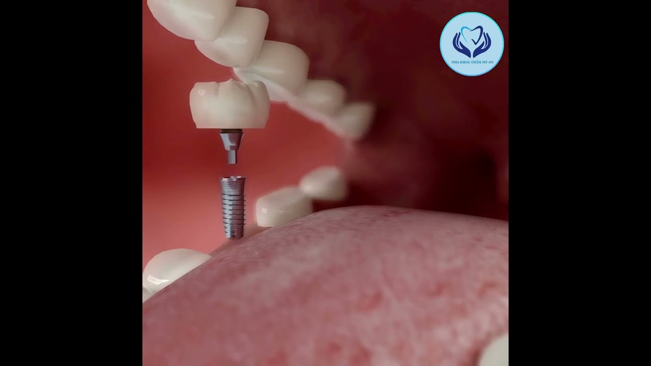 implant và quy trình mô phỏng tại nha khoa thẩm mỹ 470
