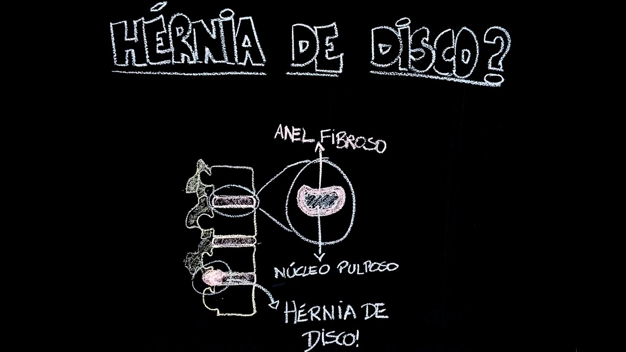 Hérnia de disco? | Anatomia e etc.