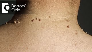 How do you get rid of skin tags naturally? - Dr. Madhu SM