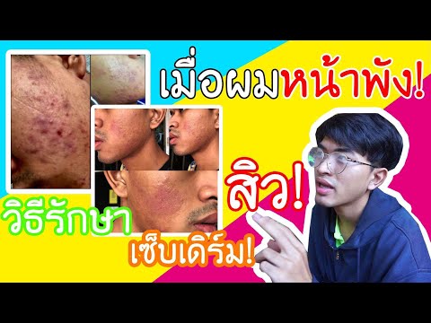 การเปลี่ยนแปลงเล็บเช่นกลาก โรคสะเก็ดเงินบนเล็บ, การรักษา