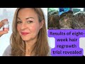 does this stem cell derived serum reverse hair loss calecim 8 week results revealed