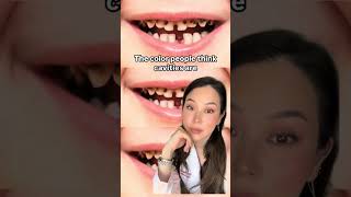 What a cavity actually looks like. #cavity #cavities #decay #dentist #cosmeticdentist #filling