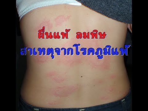 Sulsena โรคสะเก็ดเงิน ครีมทารกสำหรับโรคสะเก็ดเงิน