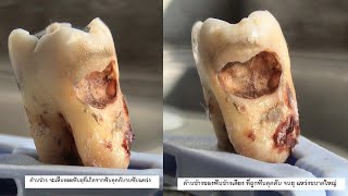 wisdom teeth removal - surgery,extraction - 15,24