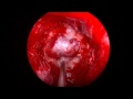 UCLA Endoscopic Pituitary Tumor Surgery