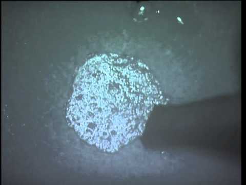 PEARL Presbyopic Inlay Soosan Jacob 1 15 min