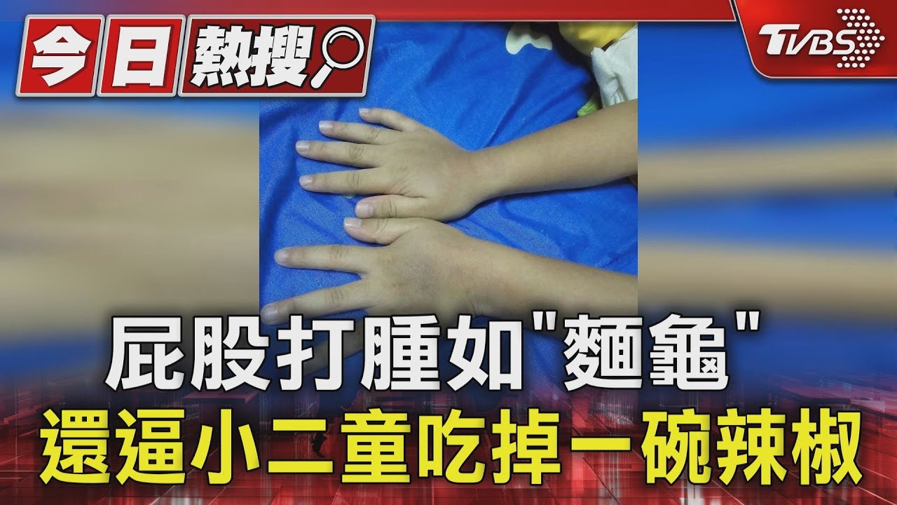 屁股打腫如「麵龜」 還逼小二童吃掉一碗辣椒
