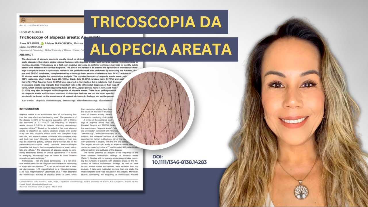 Tricoscopia da Alopecia Areata - Artigo Científico