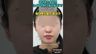 광대뼈 축소술 성형 시술
