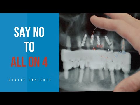 SAY NO to All on 4! I Exploring the Difference Between All-on-4 and All-on-6 Dental Implants