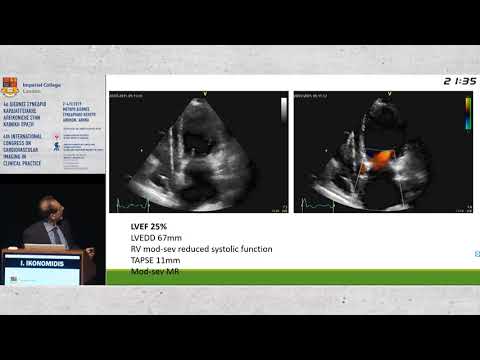 I. Ikonomidis  | Optimization of Heart Failure treatment with the utilization of imaging techniqu...