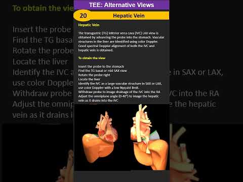 TEE: Alternative Views 20: Hepatic Vein