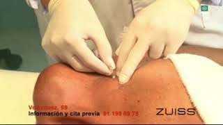 ELEVACIÓN DE MAMAS SIN CIRUGÍA (HILOS TENSORES)