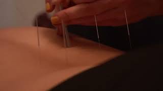 ACUPUNCTURE in MELBOURNE, FL