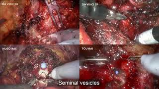V12-02: Simultaneous Step-by-Step Comparison of Four Robotic Platforms in Radical Prostatectomy