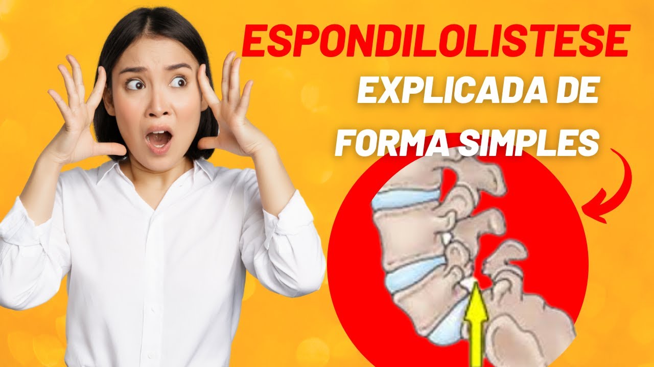 Espondilolistese explicada de forma Simples
