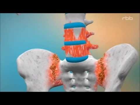 Rheuma - Heute Morbus Bechterew / Spondylitis ankylosans