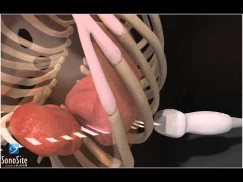 3D Lehrvideo: EFAST - Linker oberer Quadrant