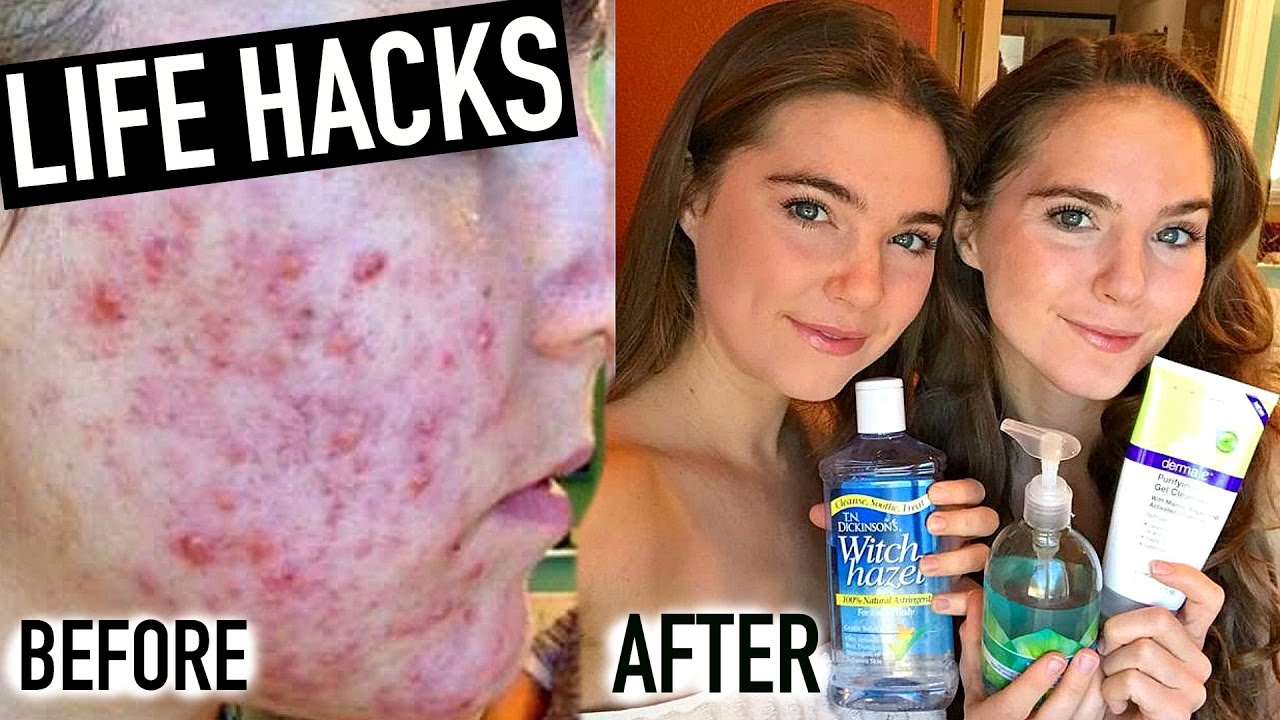15 Hacks to Clear Acne (8:15)