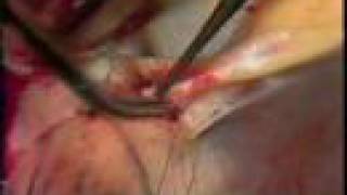 Artherosclerotic Placque Surgery