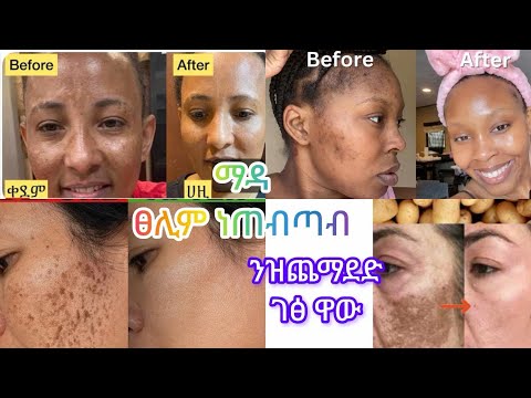 ብቡዙሓት ዝተመስከረሉ ንቡዙሓት ዘሕወየ ናይ ድንሽ ክሬም  /home made potato 🥔 cream for oll type of skin / #habesha #skin