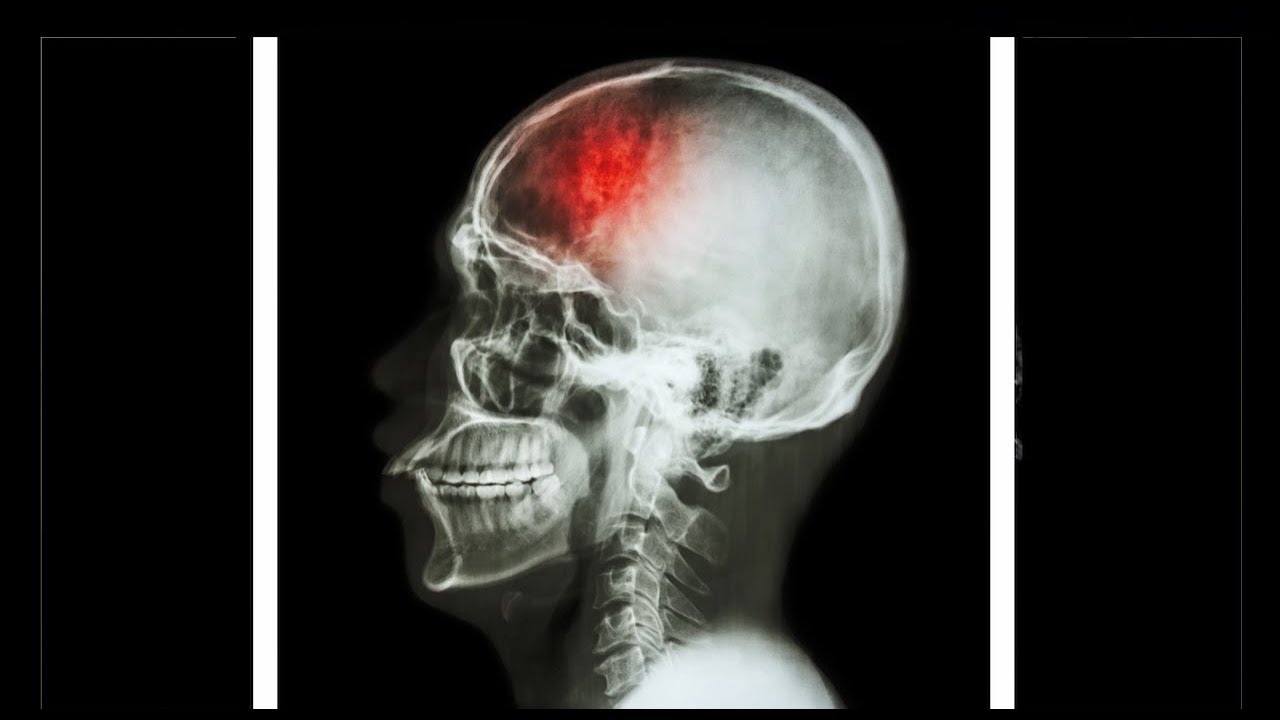 Controlled and Uncontrolled Stroke Risk Factors